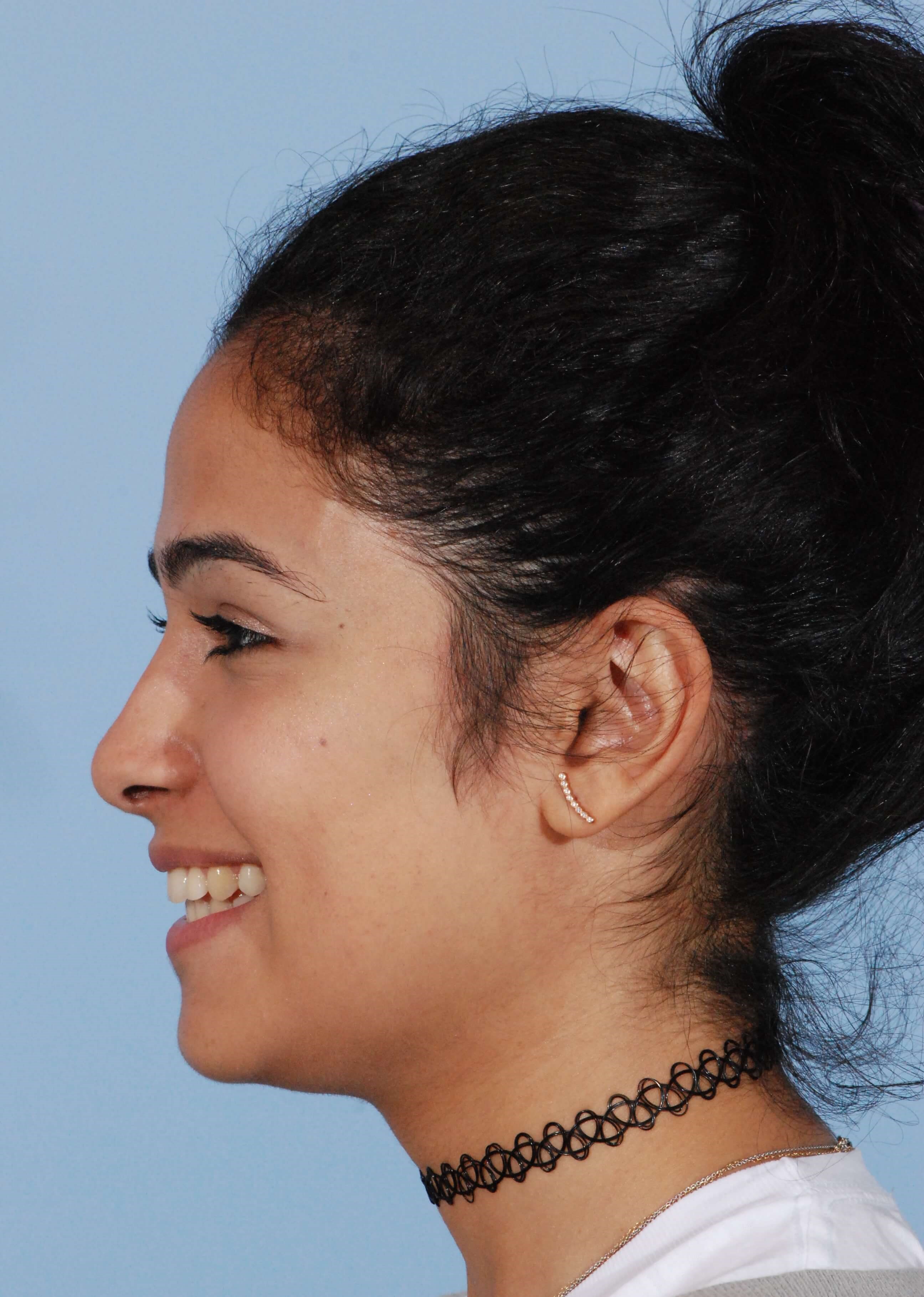 Left Smile View After