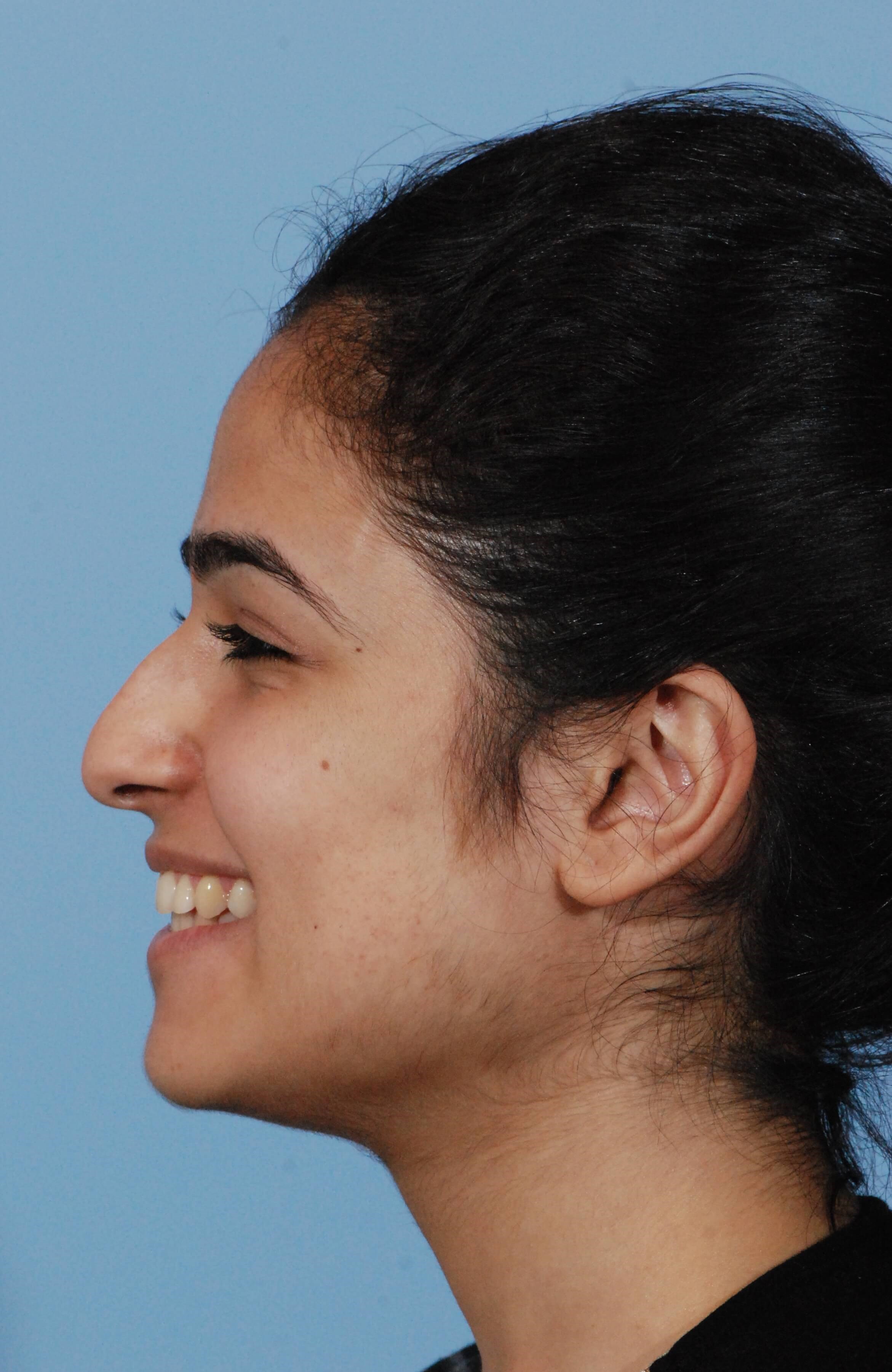 Left Smile View Before