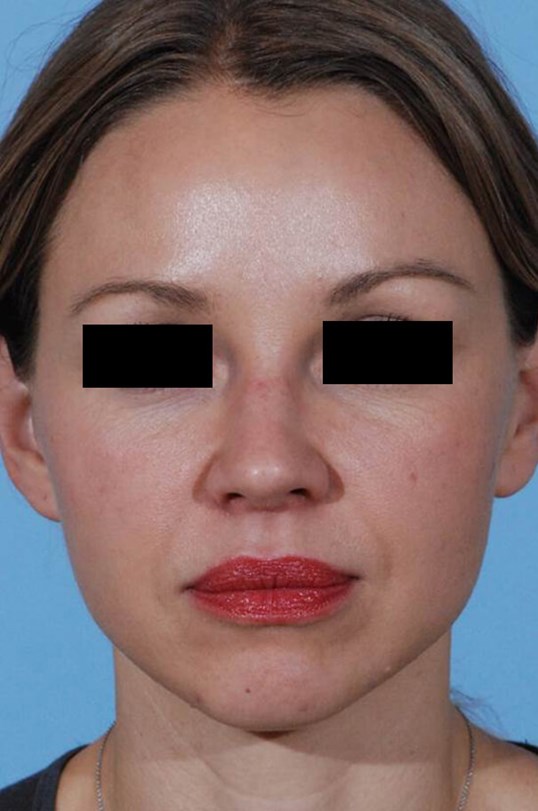Manhattan NYC Woman Prevents Aging With Mid-Facelift and Brow Lift Surgery