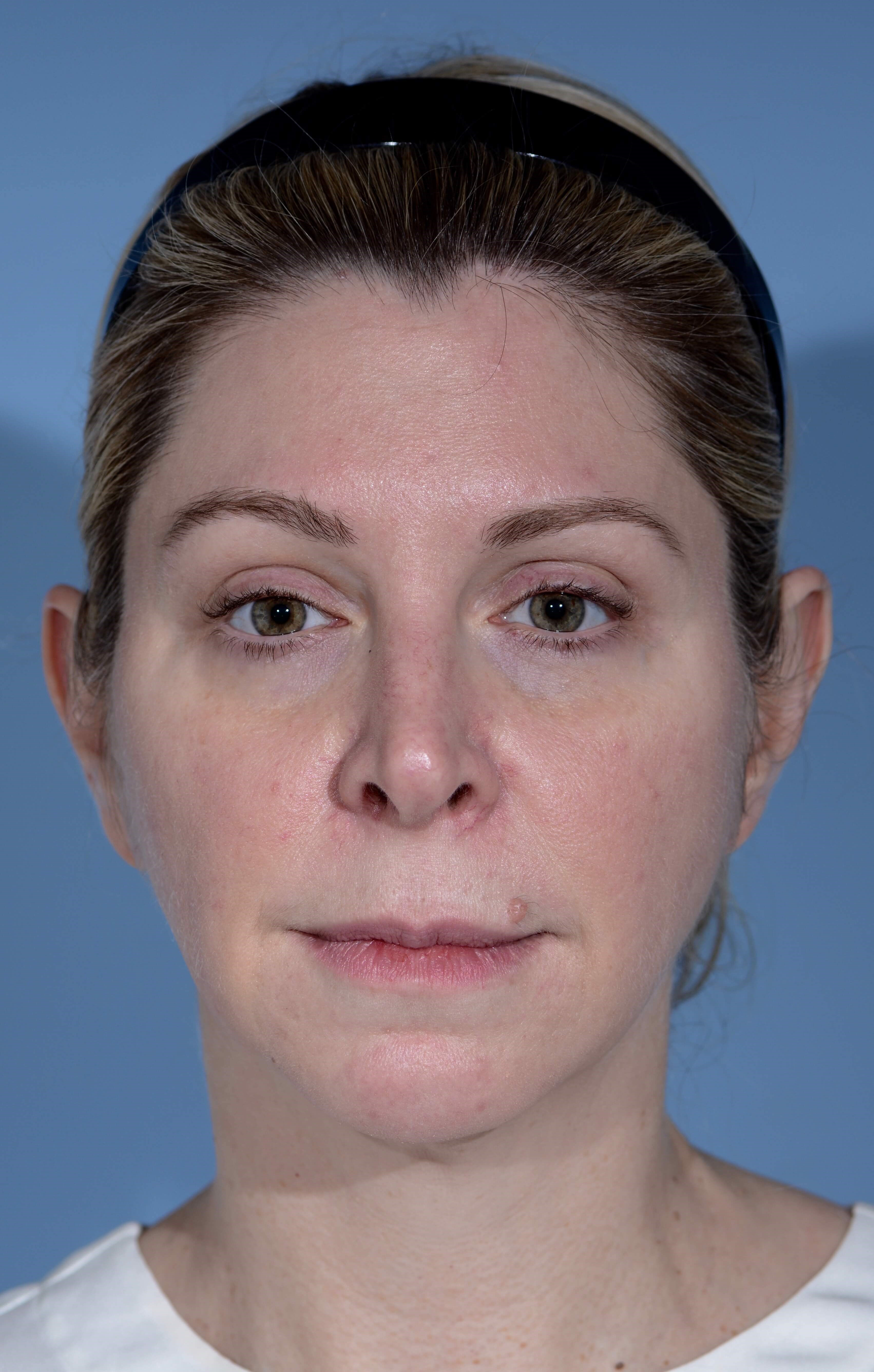 FACE NECK Before