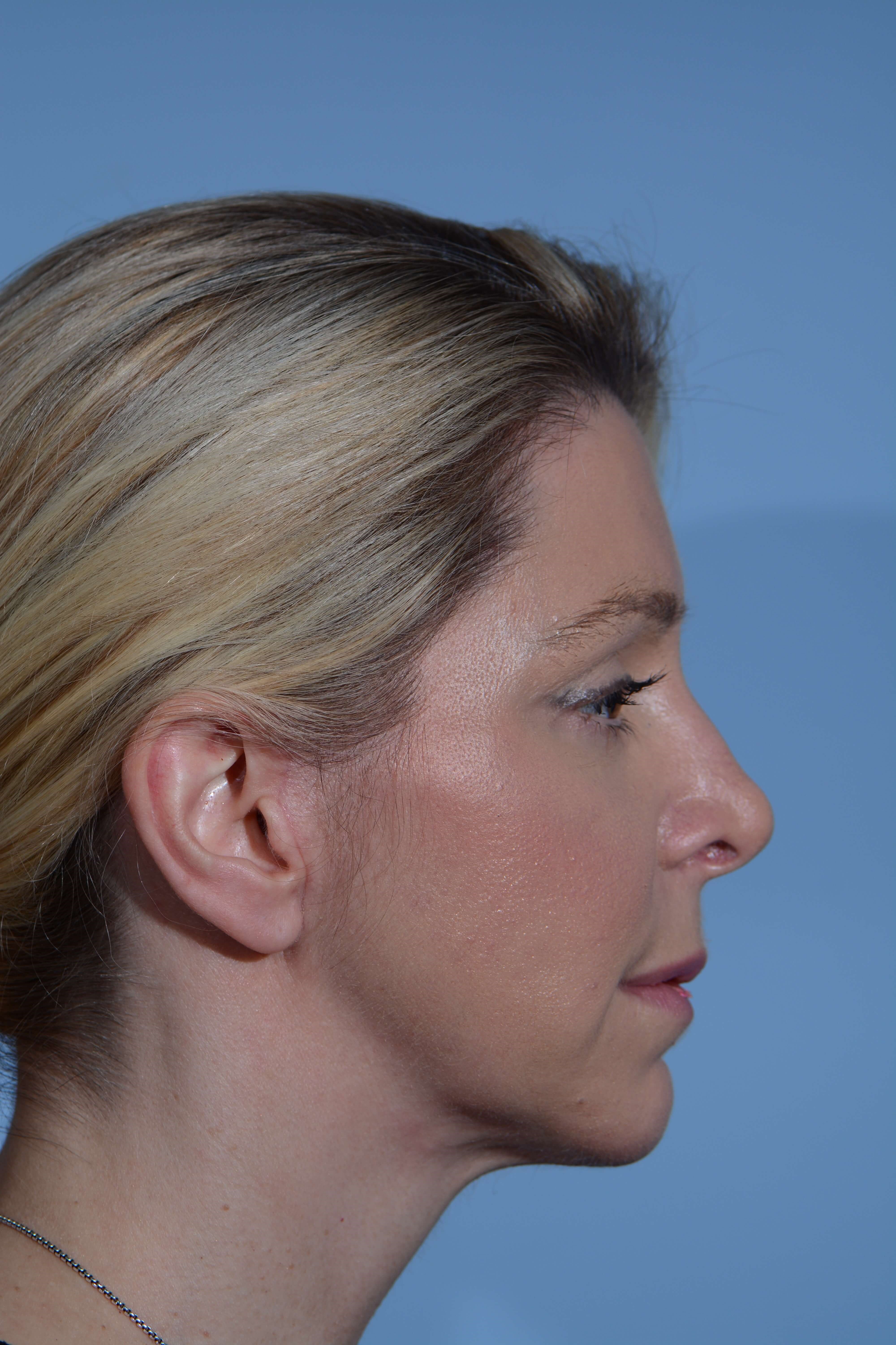 Face Neck Eyes Nose After
