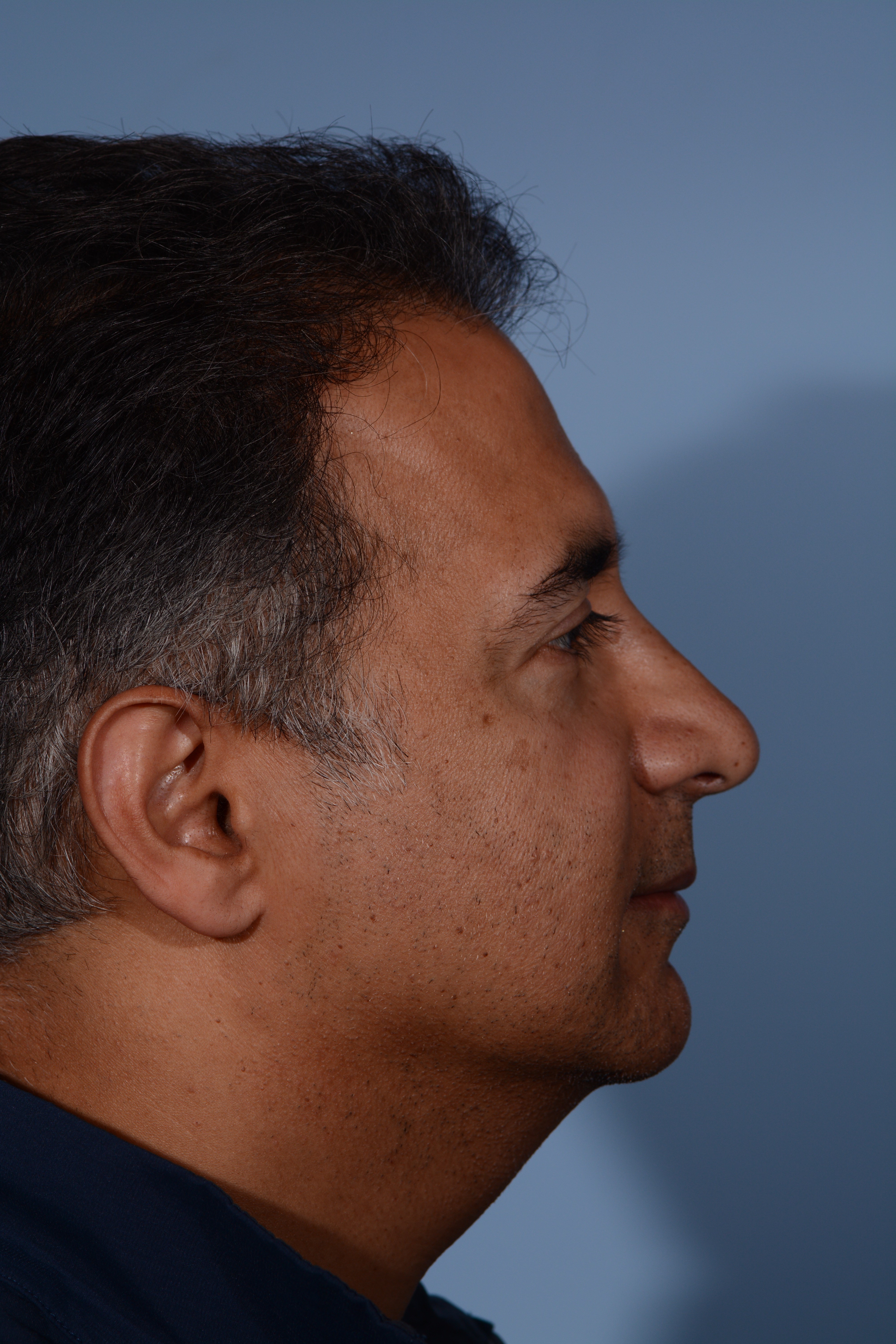 Rhinoplasty Before & After After