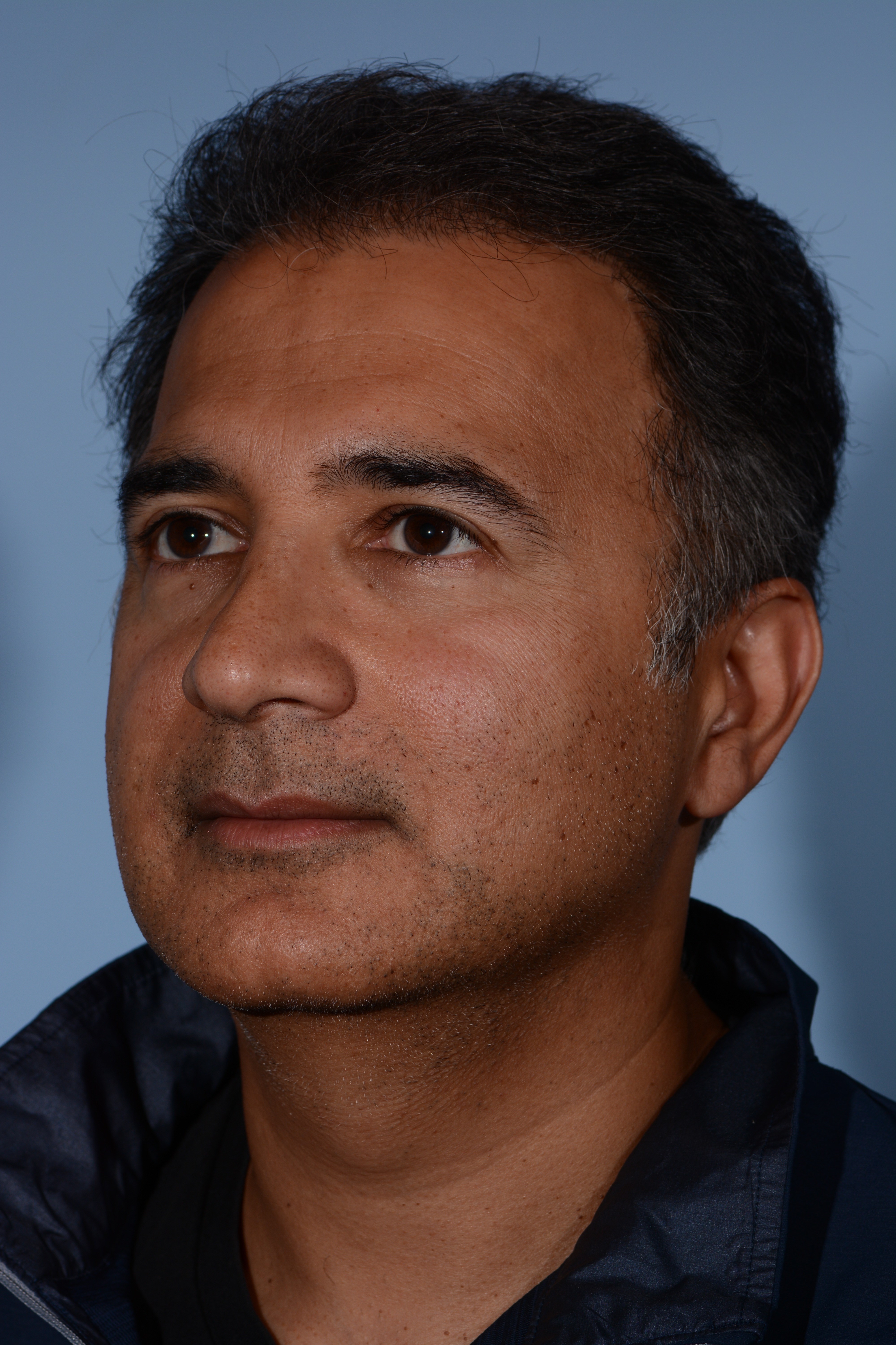 Male Rhinoplasty After