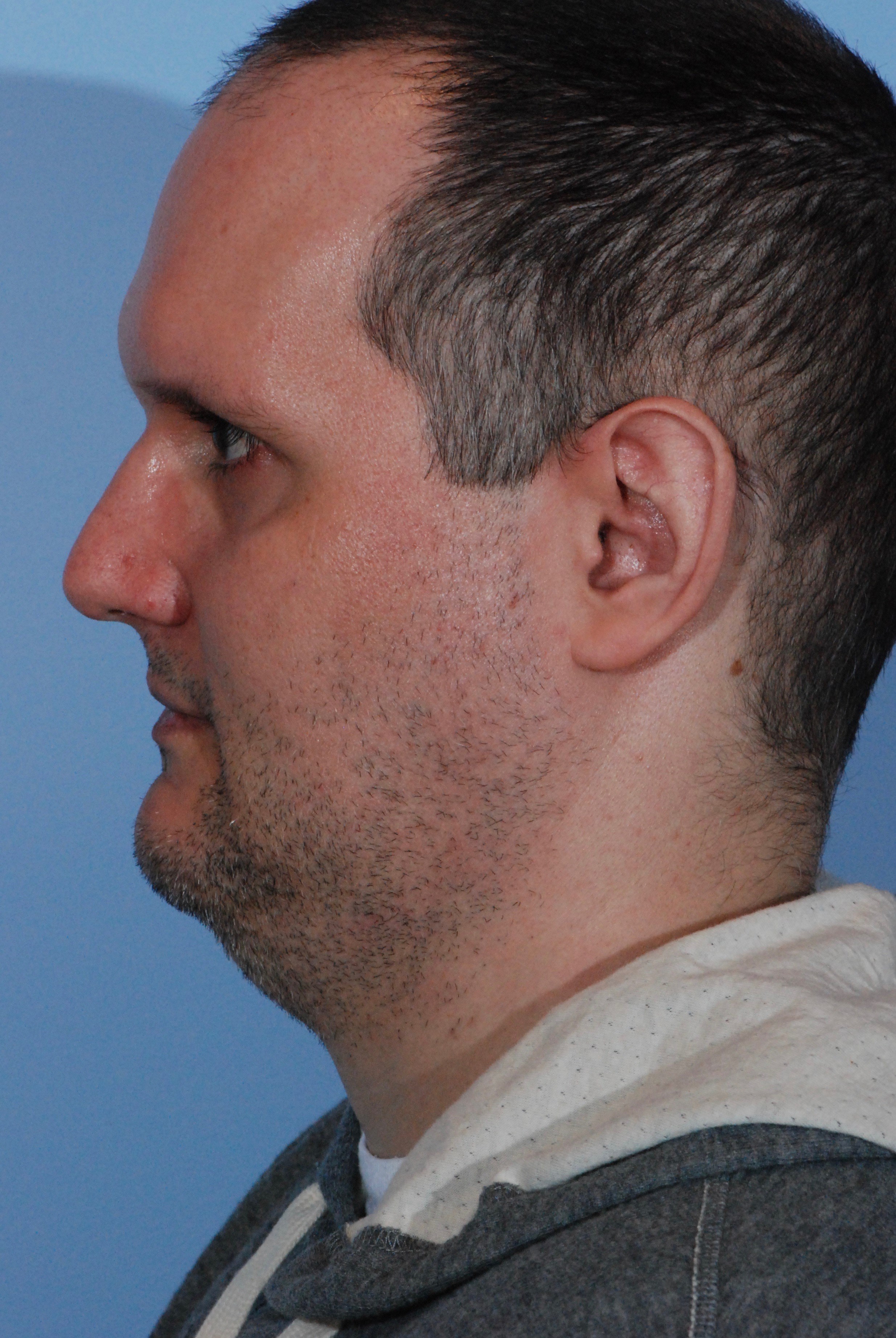 Male Neck Liposuction Before