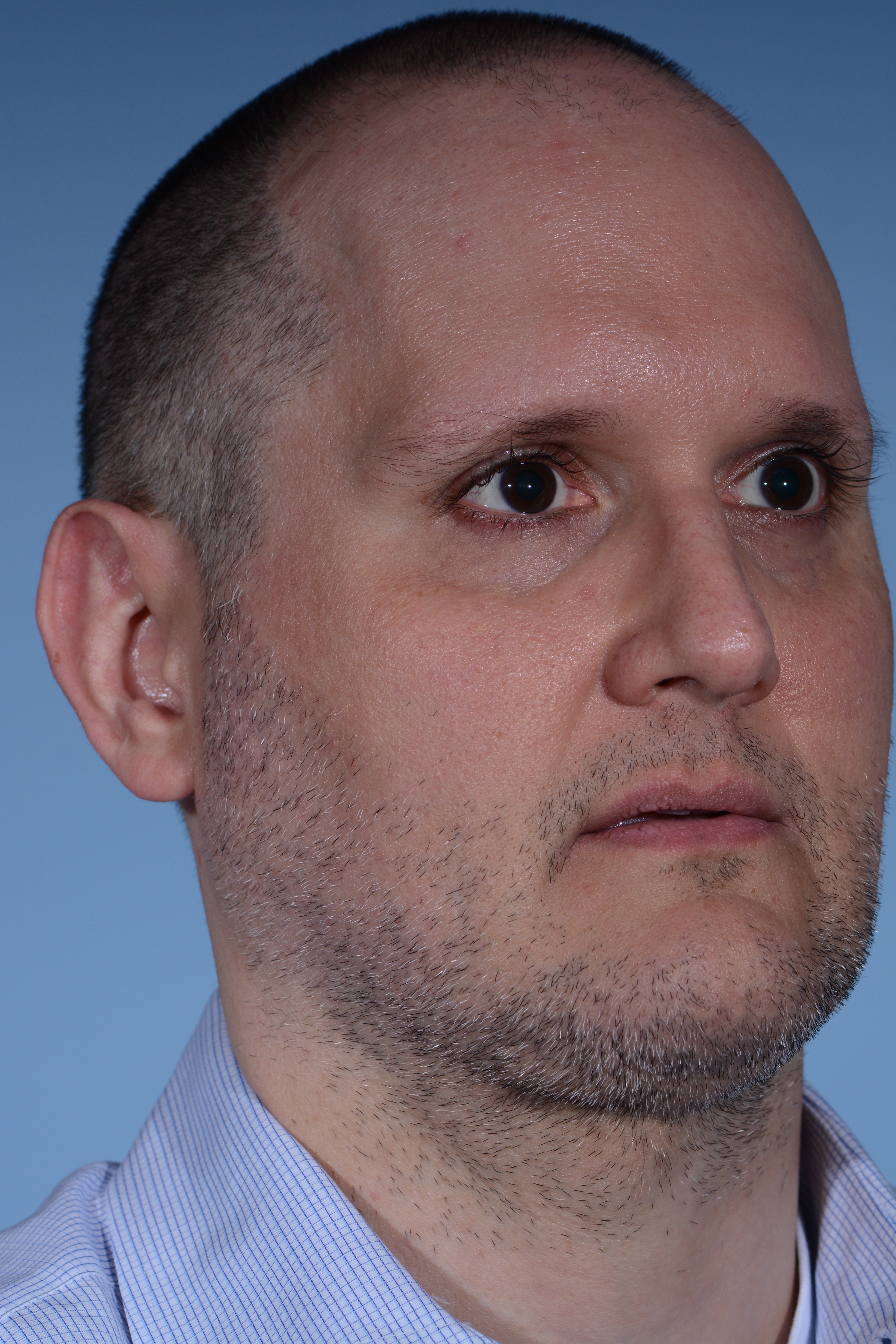 Male Neck Liposuction After