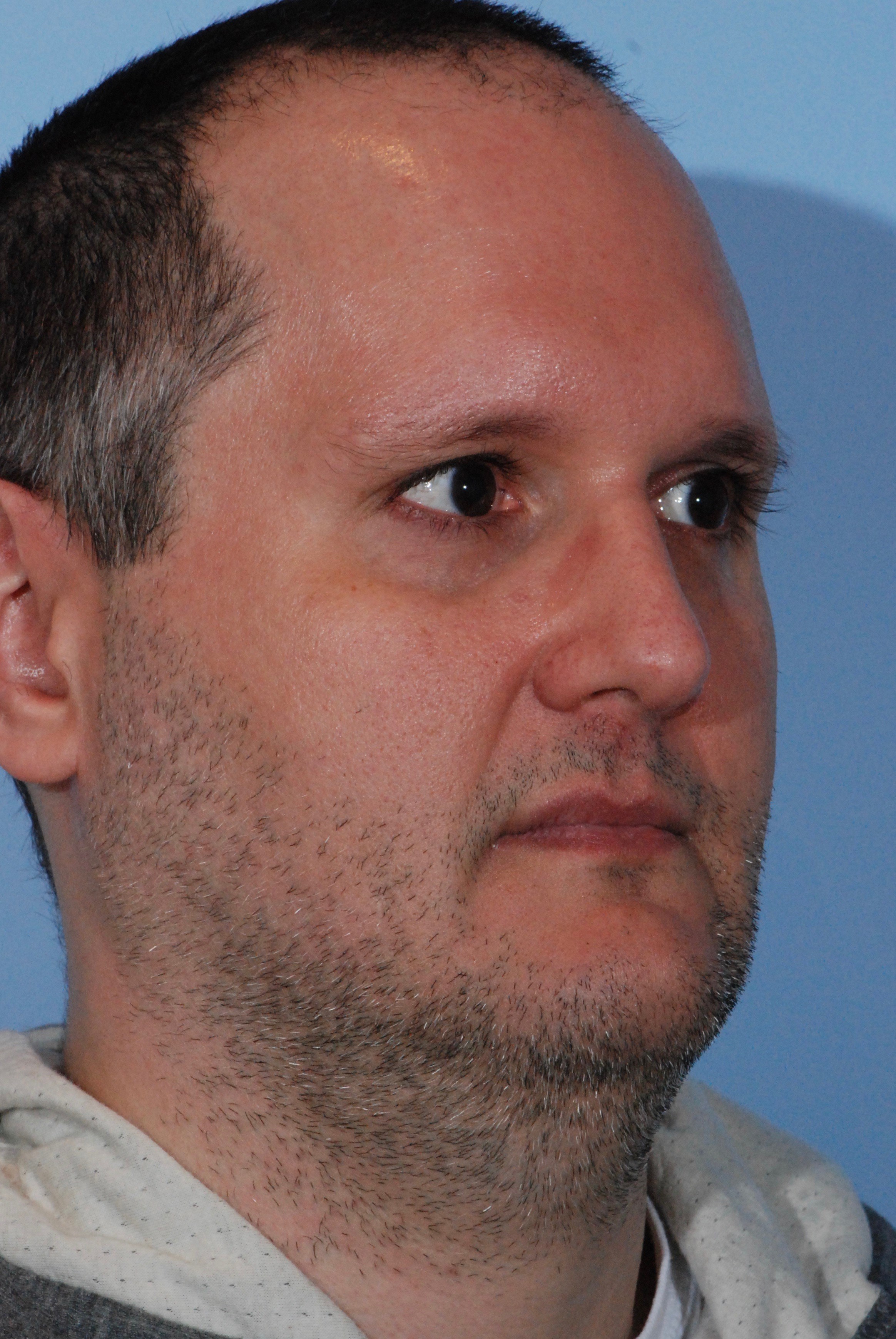 Male Neck Liposuction Before