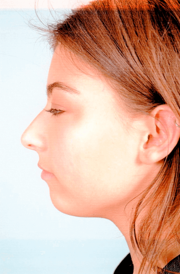 Left Profile Before