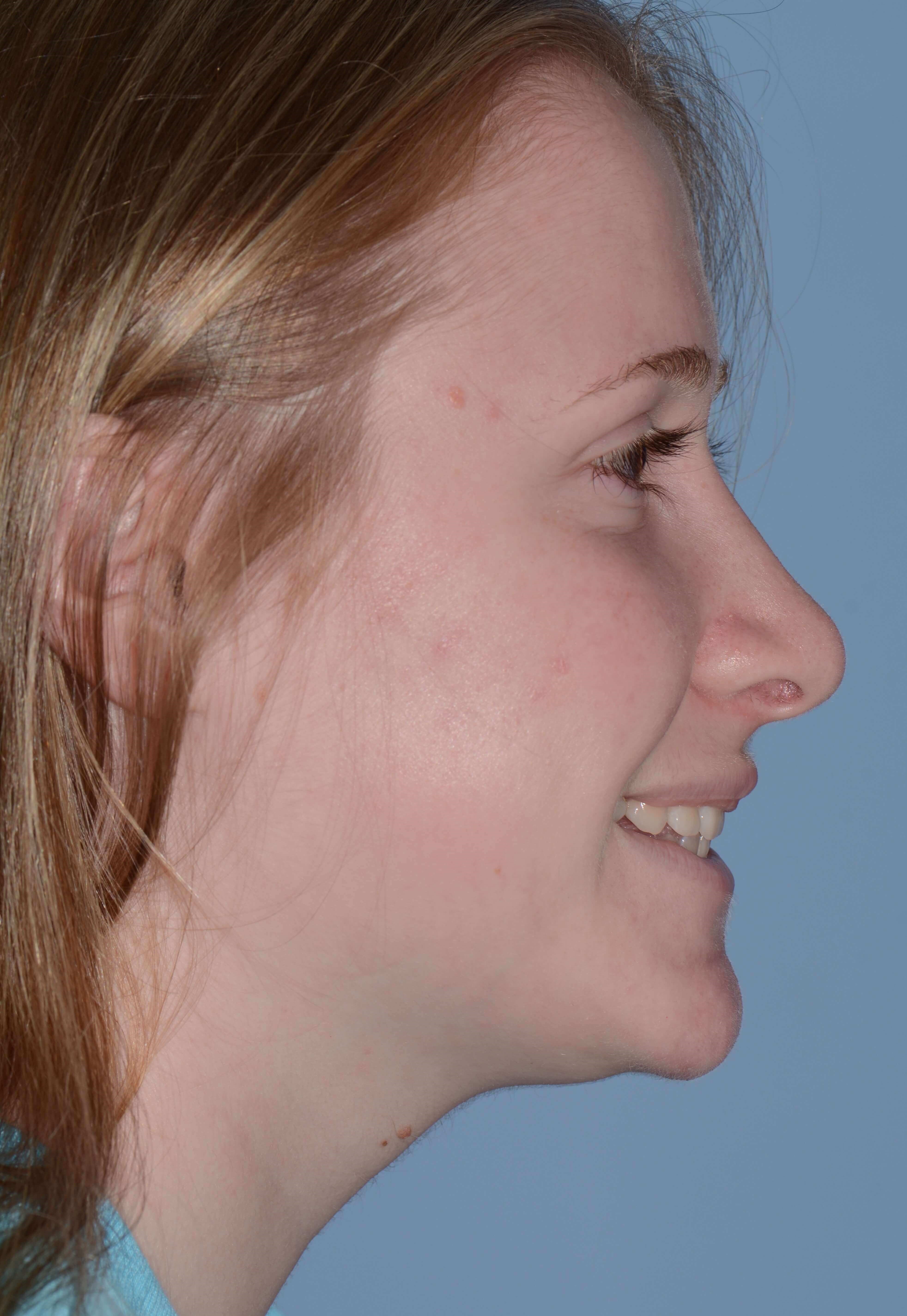 Right Profile View After