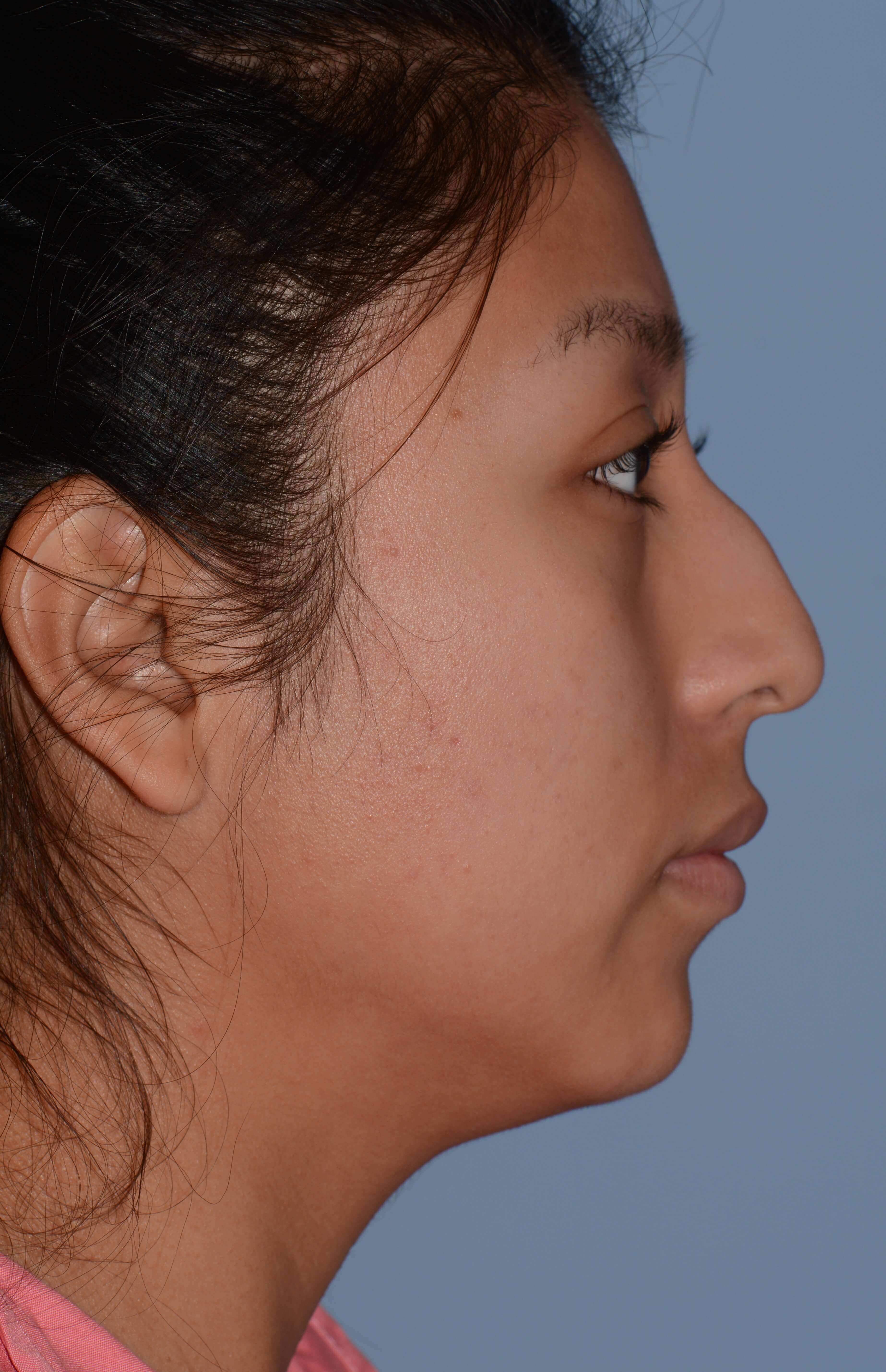 Right Profile View Before