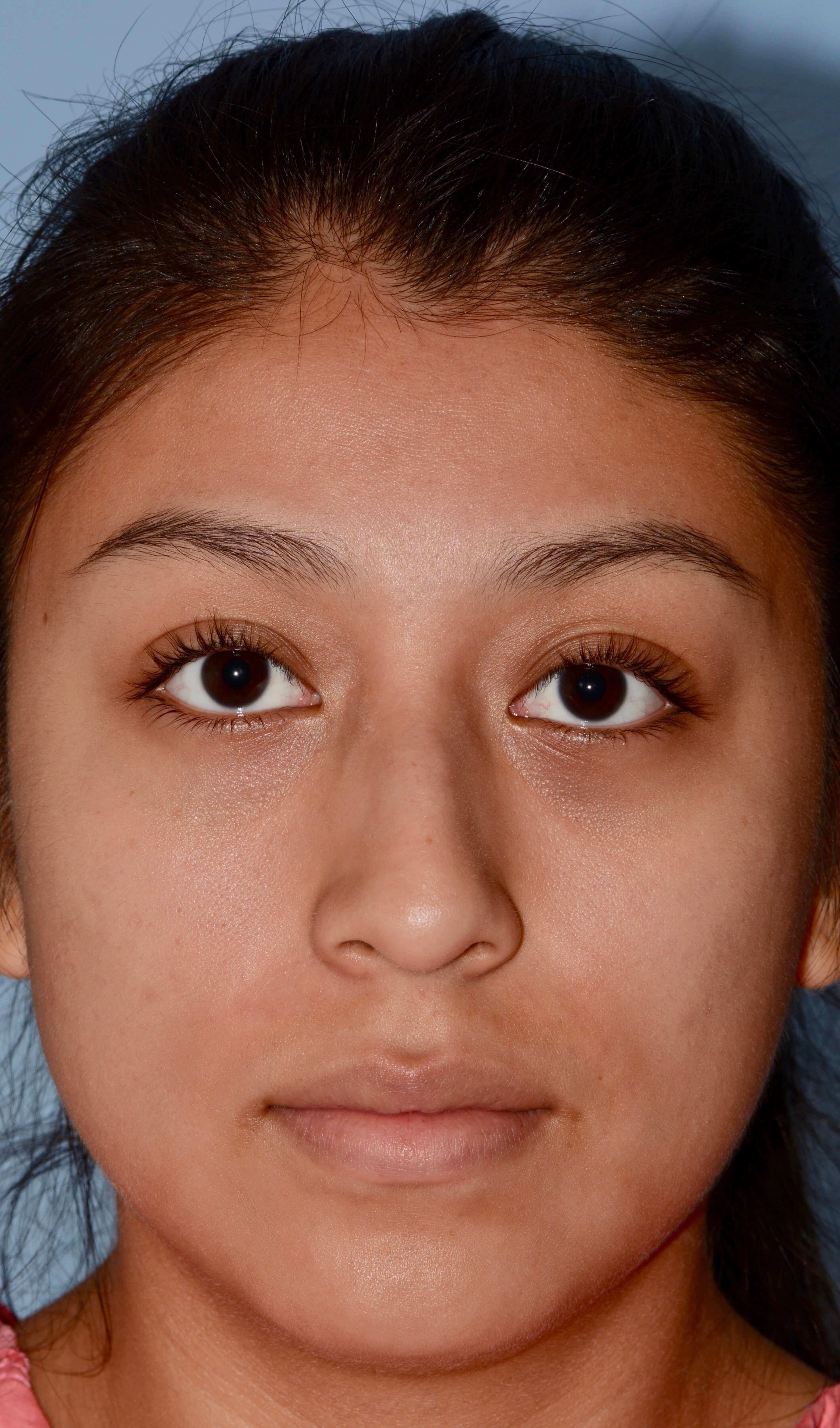 Front View Before