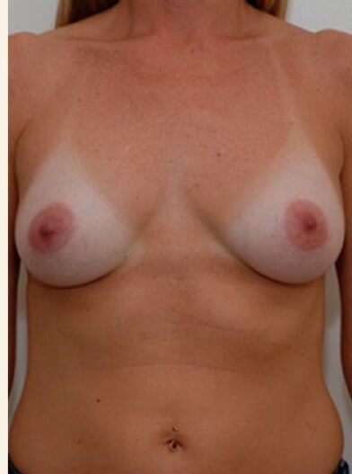 Front view After