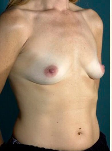 Right oblique view Before