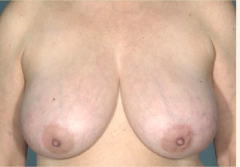 Front view Before