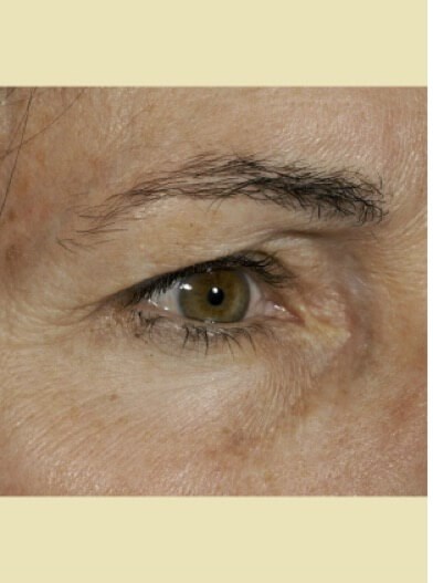 Right eye close up Before