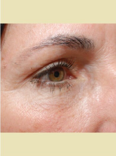 Right eye close up After
