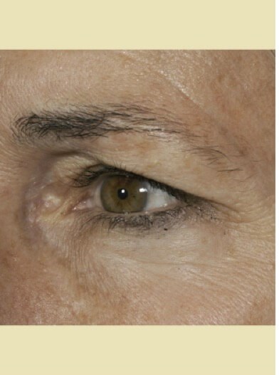 Left eye close up Before