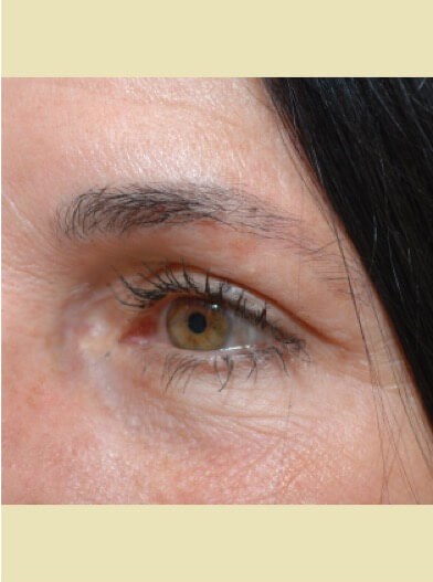 Left eye close up After