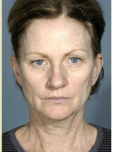 Front view Before
