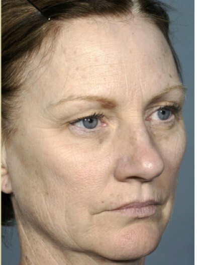Right oblique view Before