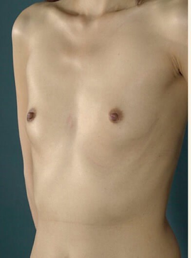 Left oblique view Before