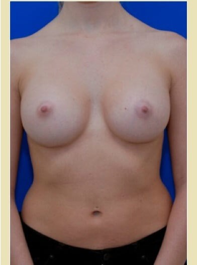 Front view After