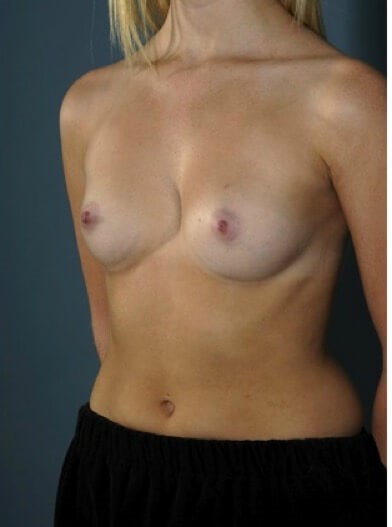 Left oblique view Before