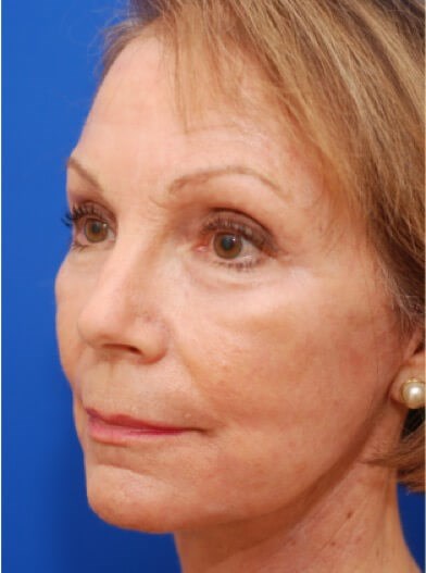 Left oblique view After