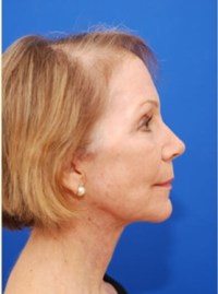 After Image