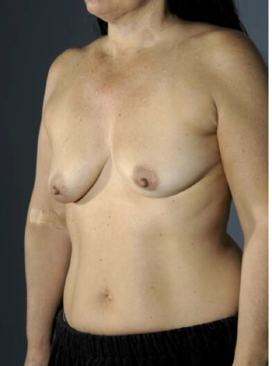Left oblique view Before