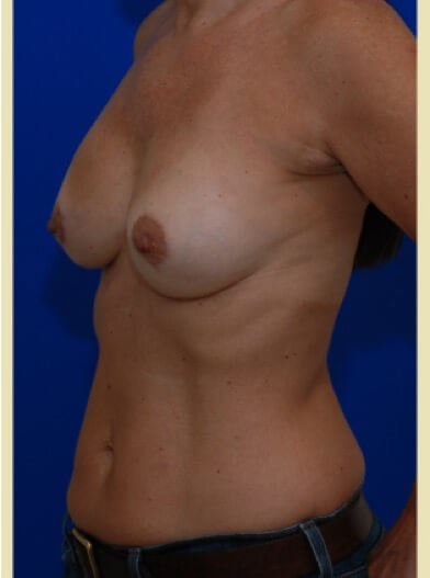 Left oblique view After