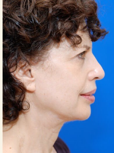Right profile view After