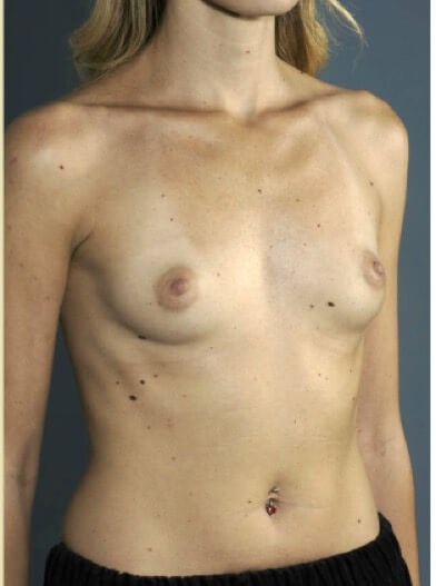 Right oblique view Before
