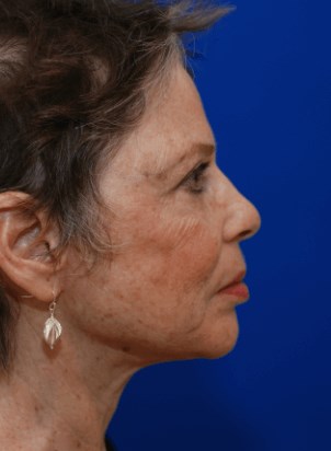 Right profile view After