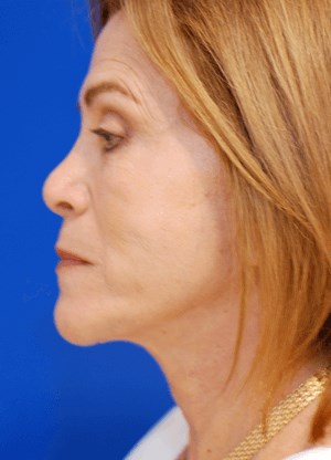 Left profile view After
