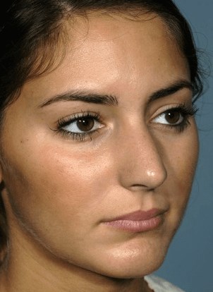 Right oblique view Before