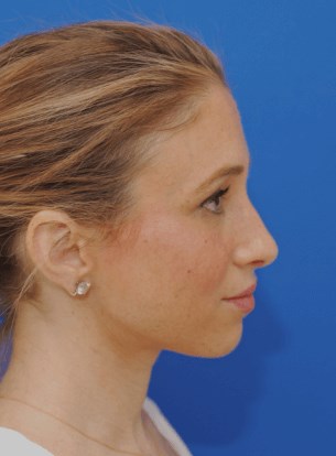 Right profile view After