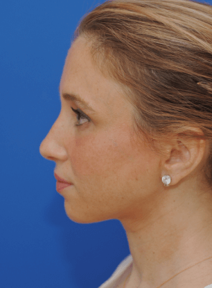 Left profile view After