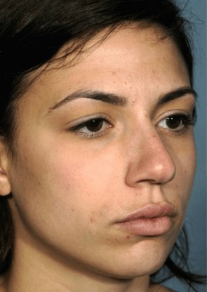 Right oblique view Before