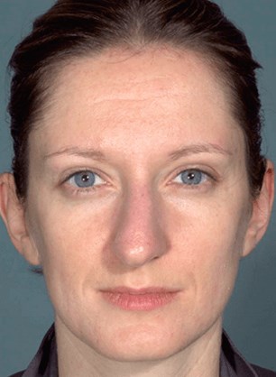Front view Before