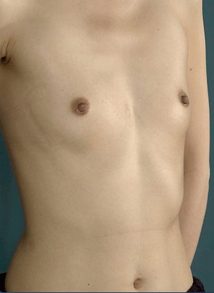 Right oblique view Before