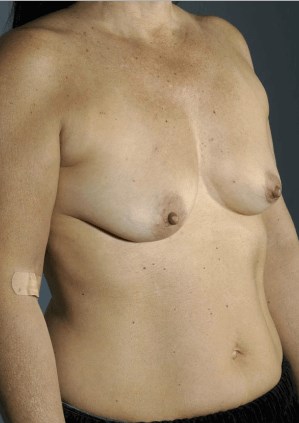 Right oblique view Before