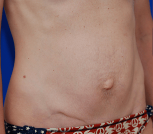 Right oblique view Before